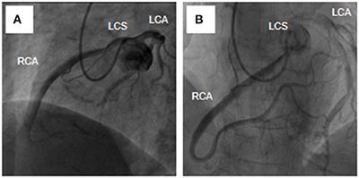 Case Report: Anomalous Origin of the Right Coronary Artery From the Left Sinus of Valsalva With Aortic Dissection: New Myocardial Ischemia Mechanism